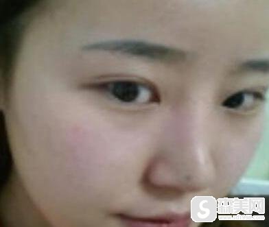 隆鼻手术前后真实案例分享，附加不同类型隆鼻手术前后果对比图