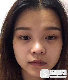 隆鼻手术前后真实案例分享，附加不同类型隆鼻手术前后果对比图