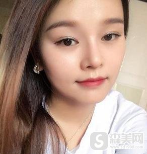 隆鼻手术前后真实案例分享，附加不同类型隆鼻手术前后果对比图