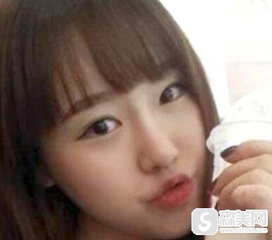 隆鼻手术前后真实案例分享，附加不同类型隆鼻手术前后果对比图