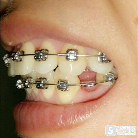 赛德阳光口腔上海南京西路门诊部进行的牙齿矫正果怎么样?
