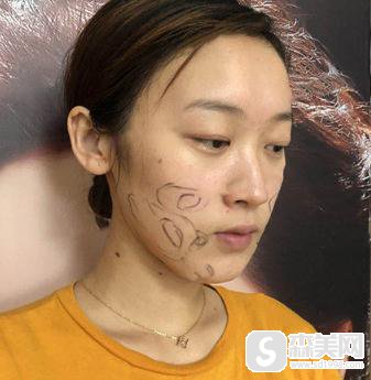 杭州美莱面部吸脂术，附案例亲身体验过程＋吸脂注意事项