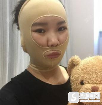 杭州美莱面部吸脂术，附案例亲身体验过程＋吸脂注意事项