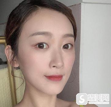 杭州美莱面部吸脂术，附案例亲身体验过程＋吸脂注意事项