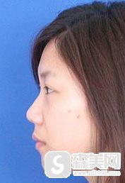 重庆真伊医疗美容医院怎么样？口碑情况+专家介绍+隆鼻案例分享！