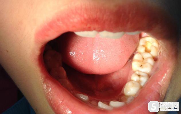 湖州龋齿治疗整形医院哪家好？龋齿治疗整形案例+口碑介绍+医师介绍