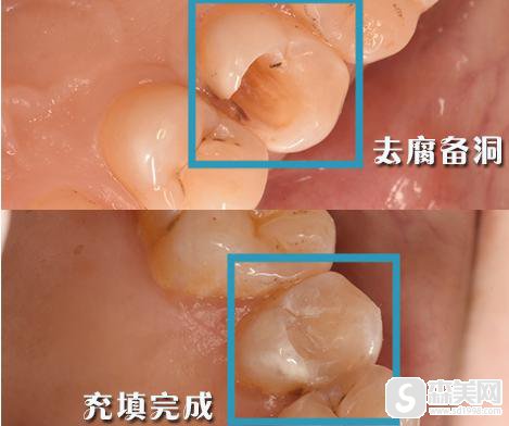 湖州龋齿治疗整形医院哪家好？龋齿治疗整形案例+口碑介绍+医师介绍