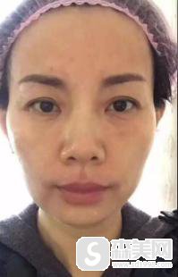 眼部除皱要多少钱？附眼部除皱案例+眼部除皱真人案例对比图