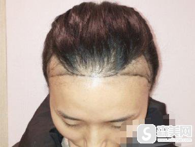 上海第九人民医院价目表2020，植发价格，内含植发案例果图