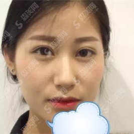 深圳北大医院整形价目表2021注射瘦脸注射果？内附注射瘦脸注射康复过程图