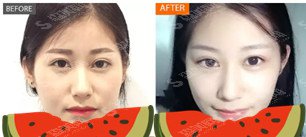 深圳北大医院整形价目表2021注射瘦脸注射果？内附注射瘦脸注射康复过程图