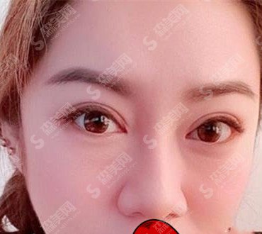 上海首尔丽格医生专家怎么样？洪性范医生的技术特色+案例果图分享