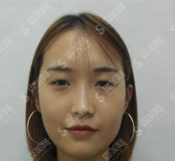 整形专家臧梦青眼部手术专业吗？北京八大处/口碑如何/案例展示