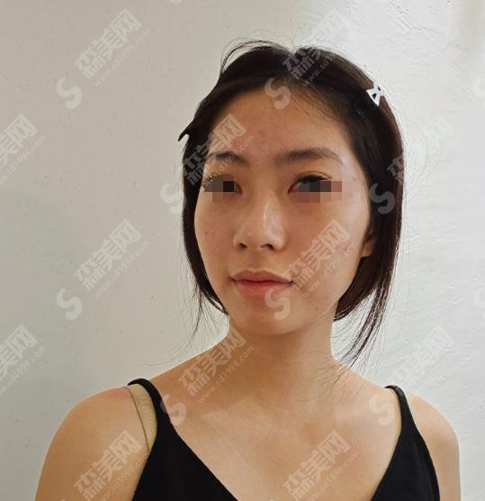 李斌斌医生怎么样？李医生做的隆鼻好不好附医院简介及李医生做隆鼻的案例分享