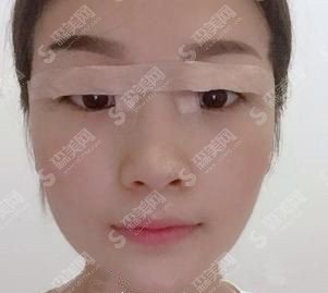 双眼皮全割整形价目表2021，双眼皮全割的果好不好？内附较新双眼皮全割的价目表