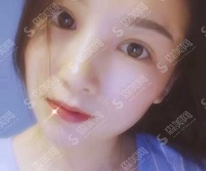 双眼皮全割整形价目表2021，双眼皮全割的果好不好？内附较新双眼皮全割的价目表