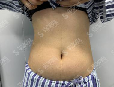 秦皇岛巧致整形价格表2021，内含腰腹吸脂术后的恢复情况