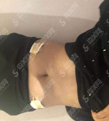 秦皇岛巧致整形价格表2021，内含腰腹吸脂术后的恢复情况