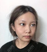 上海第九人民医院整形科价格表一览，内含面部埋线提升术后恢复反馈