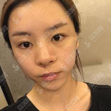 泸州陈清整形价目表2021，内含隆鼻整形详情介绍