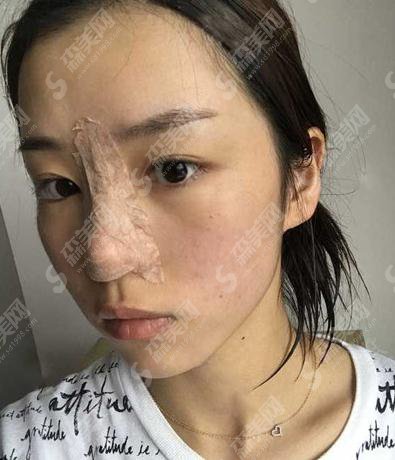 泸州陈清整形价目表2021，内含隆鼻整形详情介绍