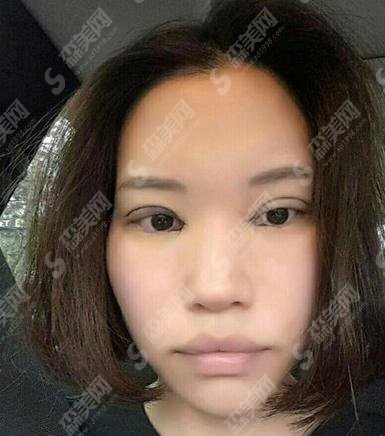 长沙你美医疗美容门诊部切开双眼皮真人案例分享新鲜出炉~