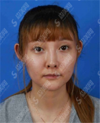 热玛吉费用贵不贵?什么项目比较贵?哪些项目便宜些呢?