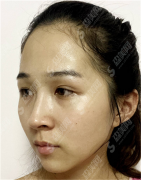 热玛吉有什么功?它会带来哪些果?没问题可靠吗?