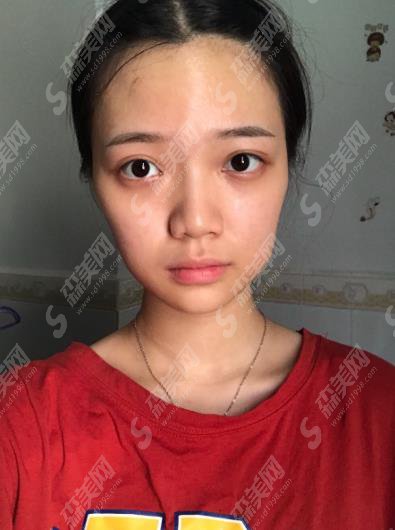 爱容整形医院面部填充多少钱？价格查询及面部填充案例图片欣赏