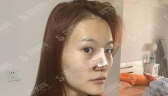 郑州隆鼻哪个医院好？郑州东方整形美容医院隆鼻案例及价格分享