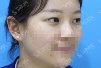 瑷珊整形医院双眼皮果超自然，求美者的不二之选！内含价格避坑小tips~