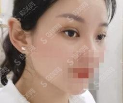 瑷珊整形医院双眼皮果超自然，求美者的不二之选！内含价格避坑小tips~