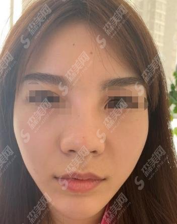 成都华美整形医院隆鼻果前后！医院口碑&专家简介，内附相关价格表
