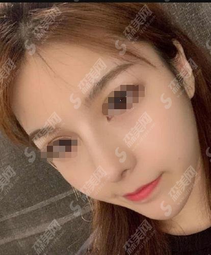 成都华美整形医院隆鼻果前后！医院口碑&专家简介，内附相关价格表