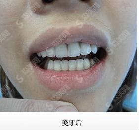 桂林医学院附属医院口腔科价格表查询，牙齿矫正使我拥有灿烂笑容！