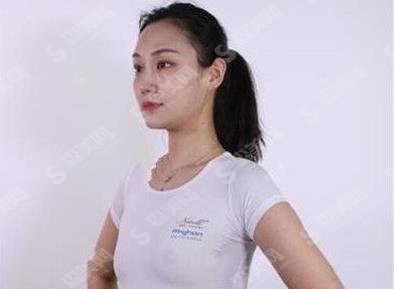 郑州大学第一附属医院整形科价格表2021，假体隆胸果可以吗？