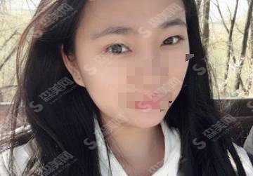 济南瑞丽医疗美容医院靠谱吗？双眼皮案例真实展现