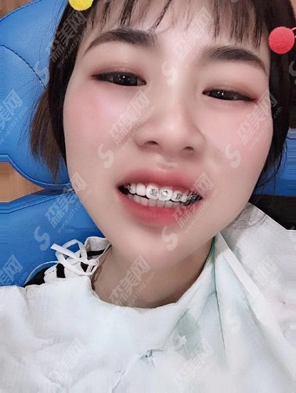 锦州市第二医院口腔科牙齿矫正做的如何？价格参考及术后果图浏览