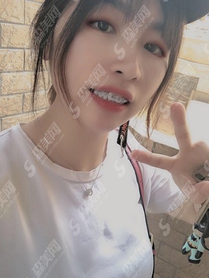 锦州市第二医院口腔科牙齿矫正做的如何？价格参考及术后果图浏览
