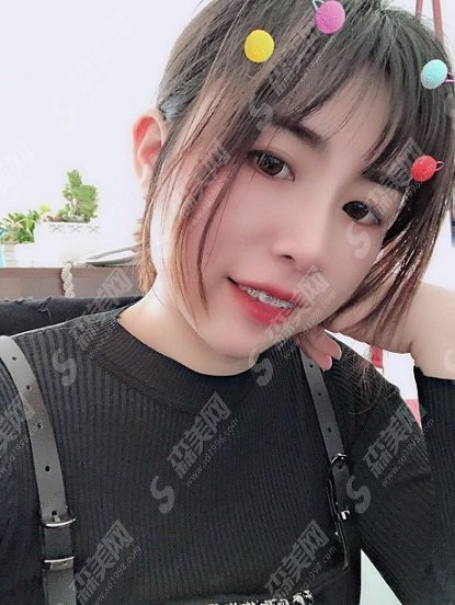 锦州市第二医院口腔科牙齿矫正做的如何？价格参考及术后果图浏览