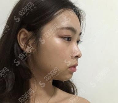 王志鹏医生的风格怎么样？面部整形案例分享及案例果！附价格表